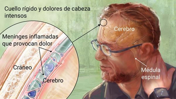 Confirman un caso de meningitis en Ushuaia pero aseguran que no es contagioso